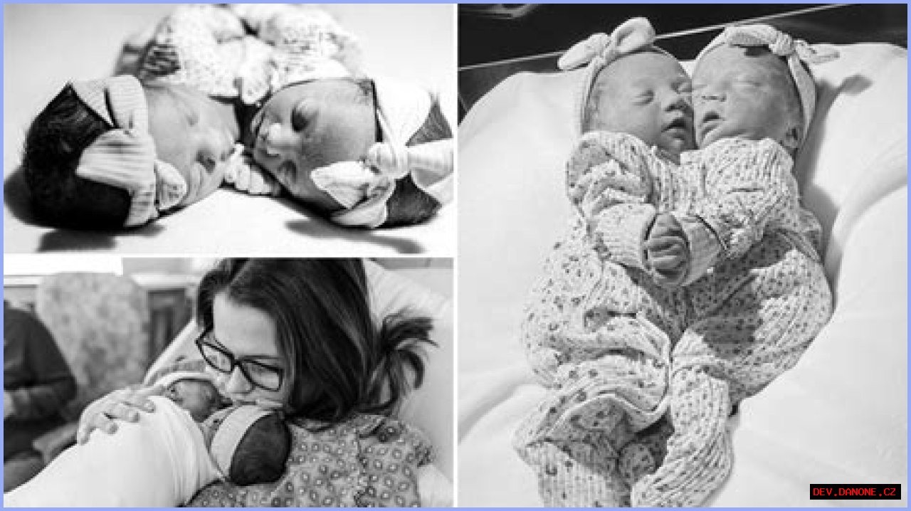 **The Inspiring Journey Of Matthew And Breana Dell: Conjoined Twins**